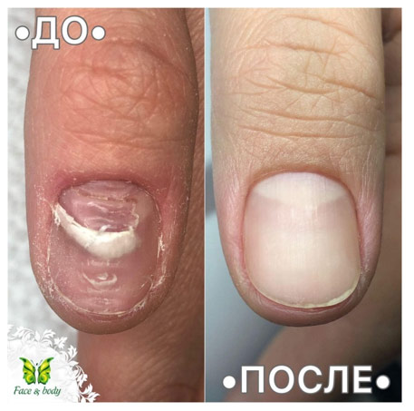 Лечение травмированного ногтя c помощью протеза из акрилата: фото «до» и «после». 
