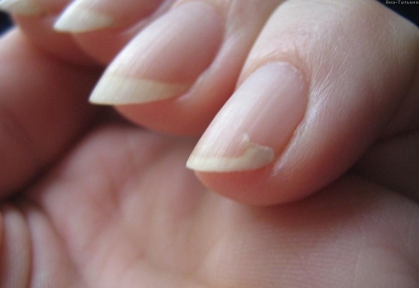Псориаз на ногтях - что это такое, признаки, лечение